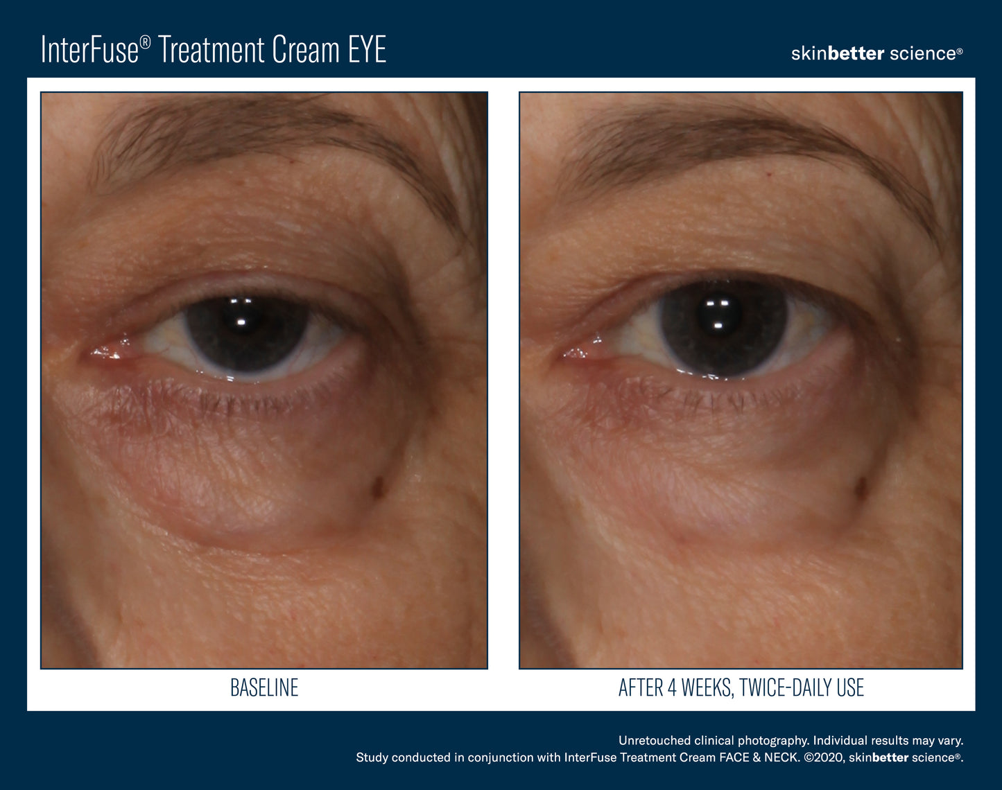 Skinbetter Interfuse Treatment Cream EYE
