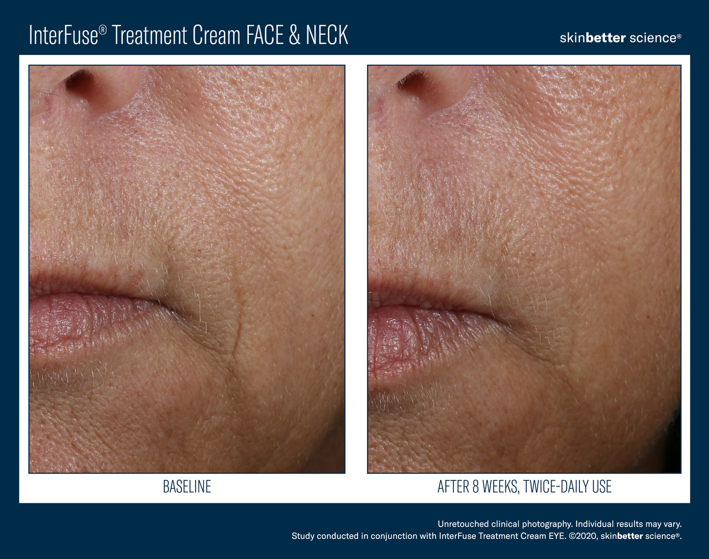 Skinbetter Interfuse Face & Neck 30 ml
