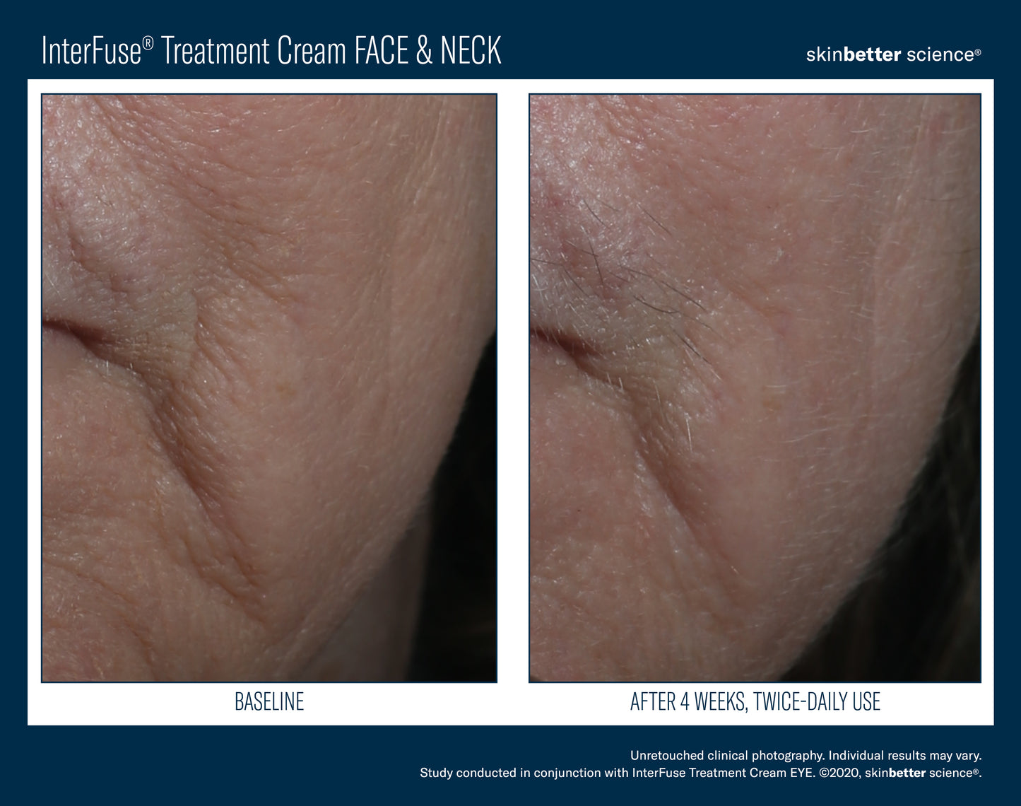 Skinbetter Interfuse Face & Neck 30 ml