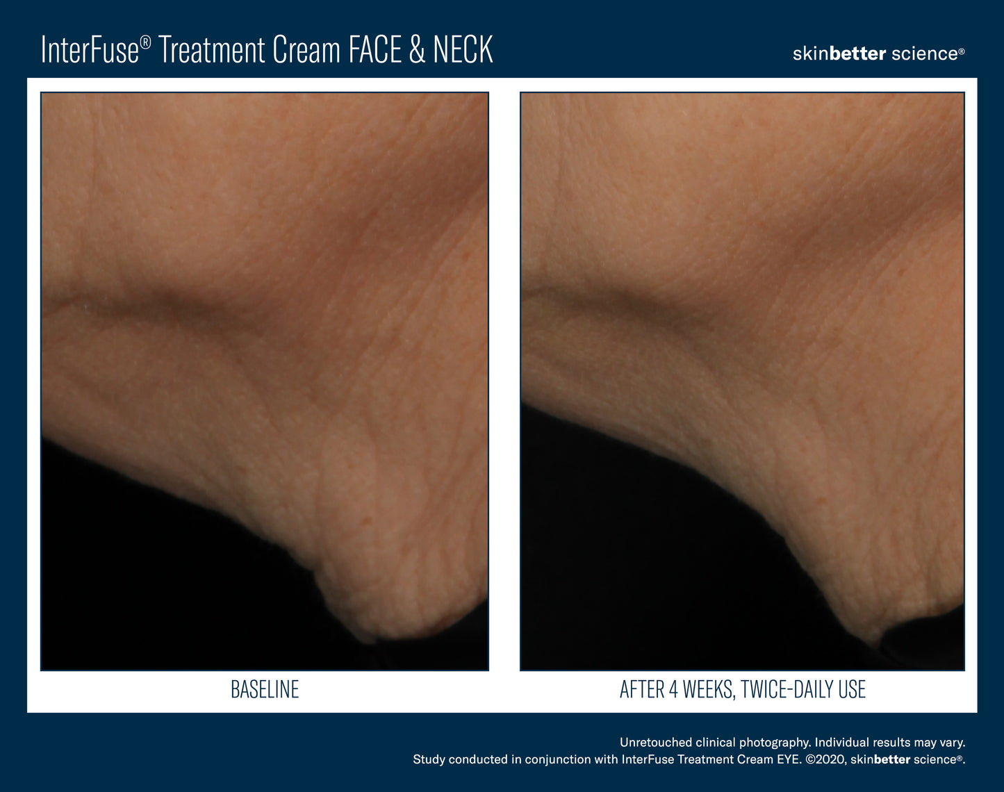 Skinbetter Interfuse Face & Neck 30 ml