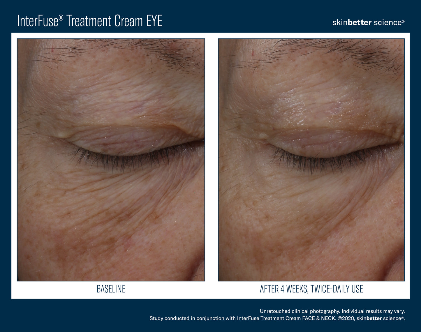 Skinbetter Interfuse Treatment Cream EYE