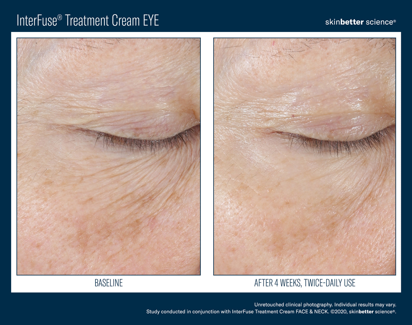 Skinbetter Interfuse Treatment Cream EYE
