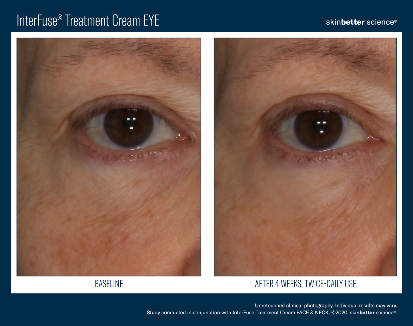 Skinbetter Interfuse Treatment Cream EYE