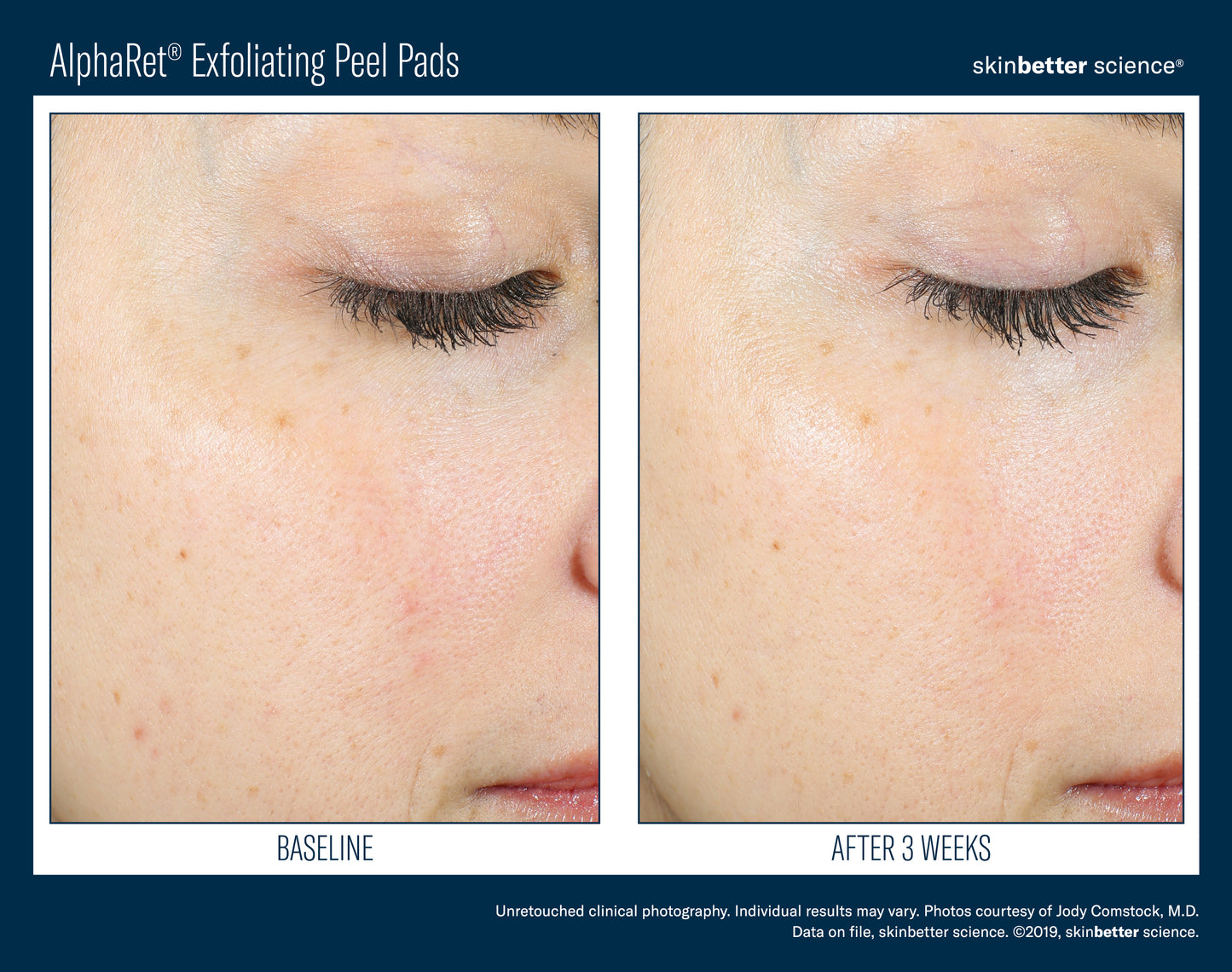 Skinbetter Alpharet Peel Pads