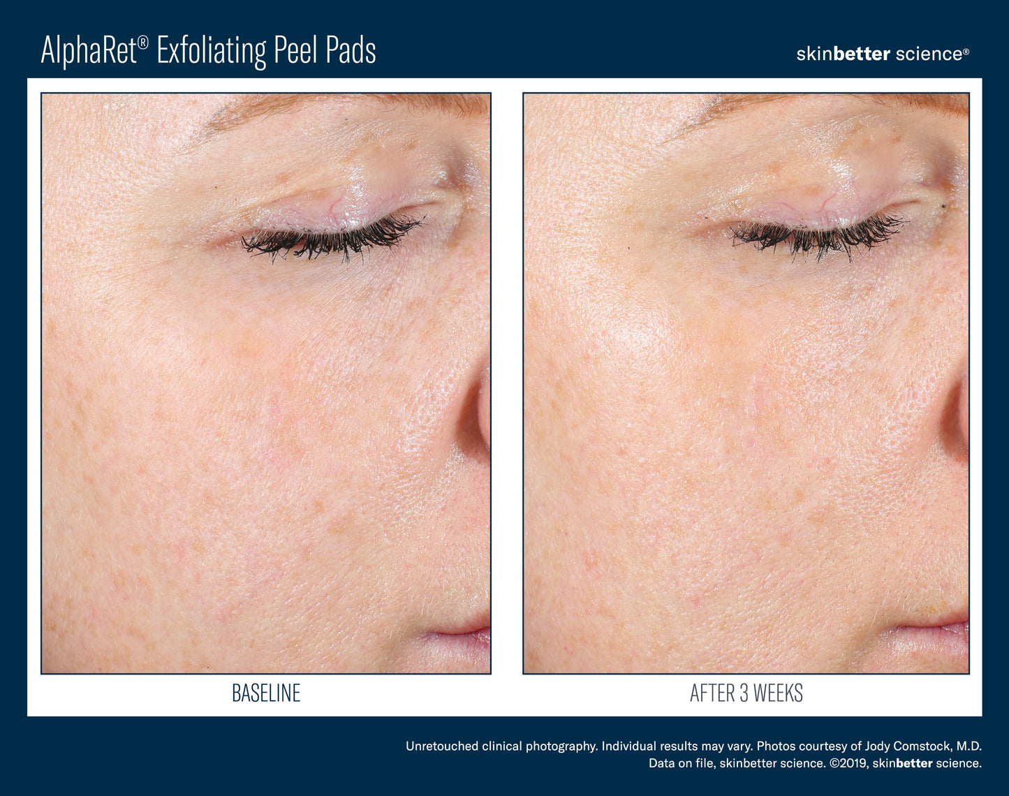 Skinbetter AlphaRet Exfoliating Peel Pads Box of 30